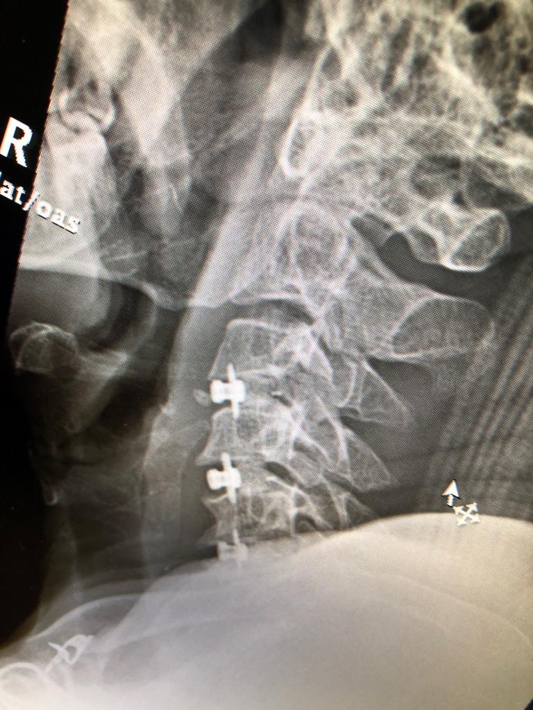 Eurospine » Locking Cage Cervical: HRCC®